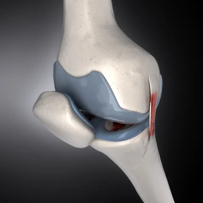 3D-Darstellung eines Knies mit hervorgehobener Verletzung.